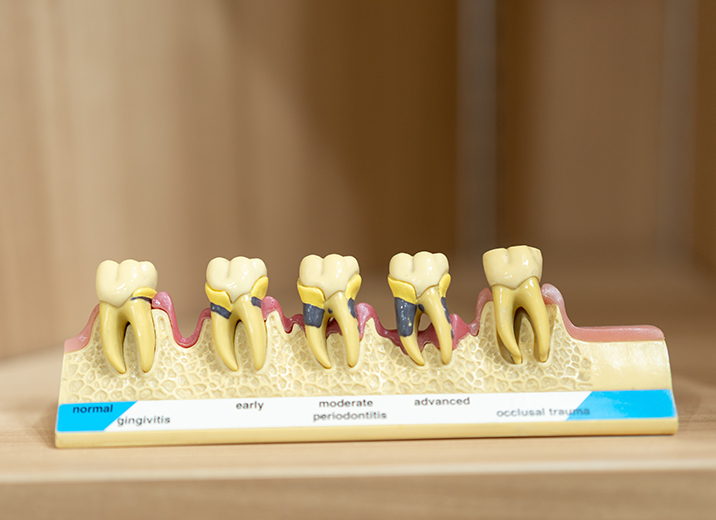 denture_02